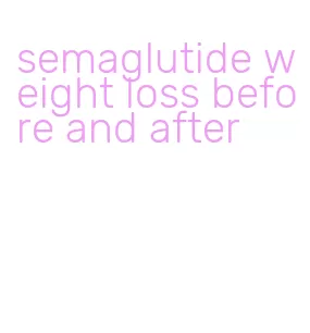 semaglutide weight loss before and after