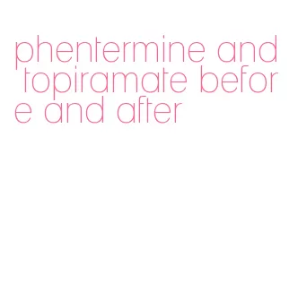 phentermine and topiramate before and after