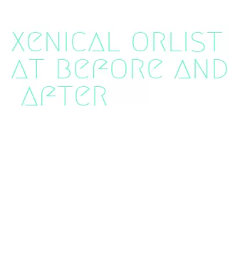 xenical orlistat before and after