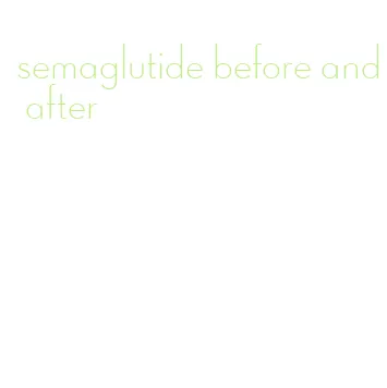 semaglutide before and after
