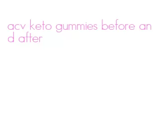 acv keto gummies before and after